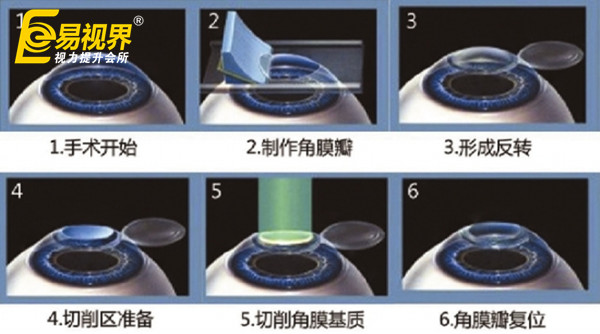 近視眼手術并非人人適宜
