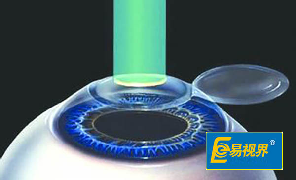 激光手術的常見后遺癥