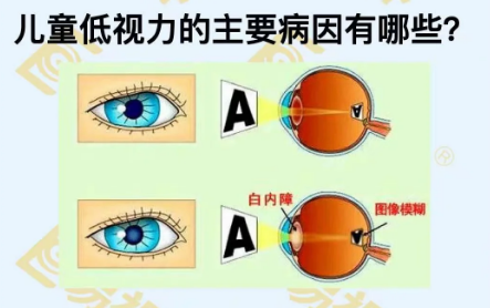 兒童低視力主要病因有哪些？