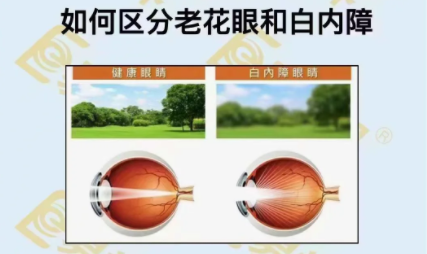 如何區(qū)分老花眼和白內(nèi)障？