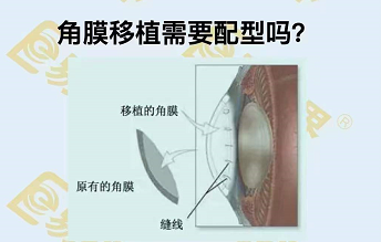 角膜移植需要配型嗎？